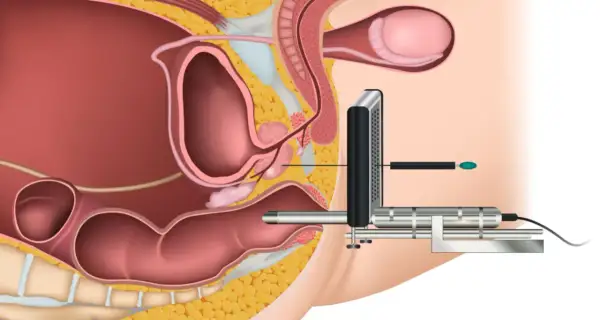 Darstellung einer MRT-gestützten Biopsie der Prostata. Ein Gerät wird in den Enddarm eingeführt, um die Prostata zu erreichen.