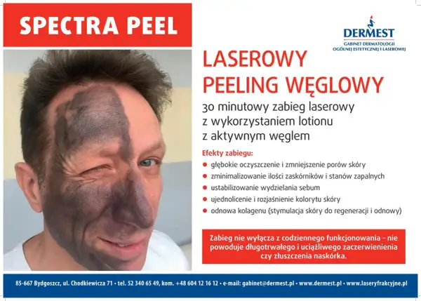Mężczyzna z połową twarzy pokrytą czarną maską węglową po zabiegu Spectra Peel. Laserowy peeling węglowy nie powoduje skutków ubocznych jak zaczerwienienie czy złuszczanie.