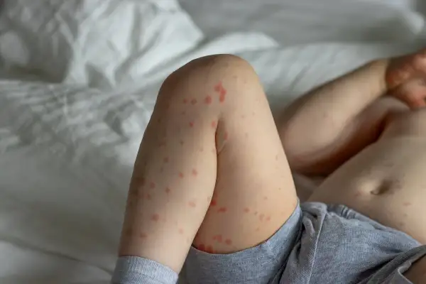 Piernas de un bebé con erupción cutánea roja, indicativo de roseola bebe.