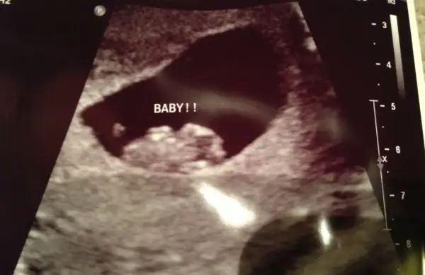 Ecografía temprana con la palabra "BABY!!" escrita. La posición del saco gestacional podría ser analizada con el método Ramzi.