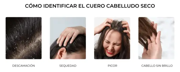 Cuatro imágenes muestran síntomas de cuero cabelludo seco: descamación, sequedad, picor y cabello sin brillo.