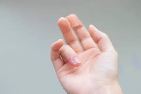 Mano con dito arrossato e gonfio, segno di infiammazione dita mano.