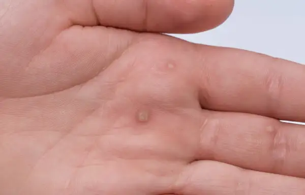 Dłoń mężczyzny z kilkoma brodawkami, które mogą być objawem wirusa HPV.