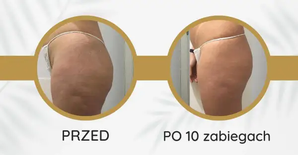 Endermologia: ile cm mniej? Realne efekty i sekrety sukcesu