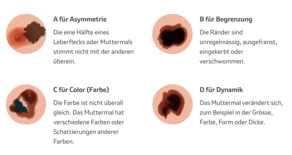 Hautveränderungen: Asymmetrie, unregelmässige Ränder, Farbwechsel und Dynamik sind Anzeichen für schwarzen Hautkrebs (Vorstufe).