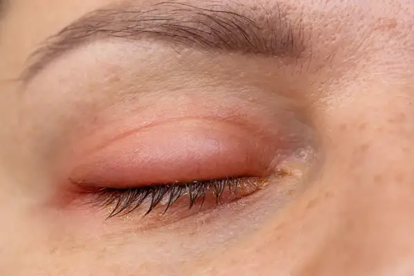 Ojos hinchados y enrojecidos, con secreción amarillenta en las pestañas. Parece que alguien lloró mucho o tiene una infección.