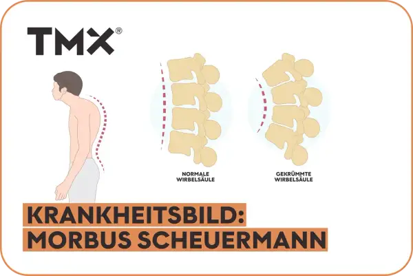 Vergleich einer normalen und gekrümmten Wirbelsäule, die das Krankheitsbild Morbus Scheuermann im Endstadium illustriert.