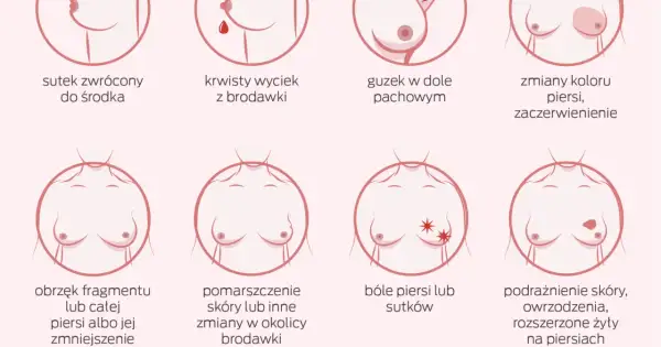 Ilustracja pokazuje objawy, które mogą wskazywać na nowotwór złośliwy sutka: zmiany brodawki, guzek, obrzęk, zaczerwienienie, ból.