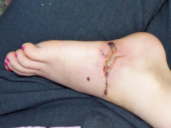 Stopa z raną pooperacyjną, która zaczyna wykazywać objawy gangreny. Widoczne są ciemne, martwicze tkanki i zaczerwienienie.