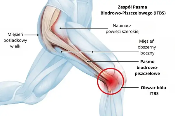 Anatomia kolana z zaznaczonym pasmem biodrowo-piszczelowym i obszarem bólu ITBS. Widoczny mięsień pośladkowy wielki i napinacz powięzi szerokiej.