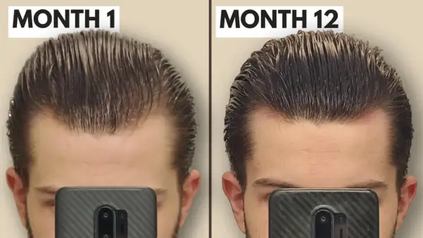 Comparaison avant/après 12 mois : le derma roller a visiblement densifié la chevelure et réduit la perte de cheveux sur le front.