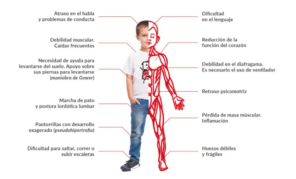 Un niño muestra los efectos de la distrofia muscular de Duchenne: debilidad muscular, problemas de lenguaje, cardíacos y respiratorios, entre otros.