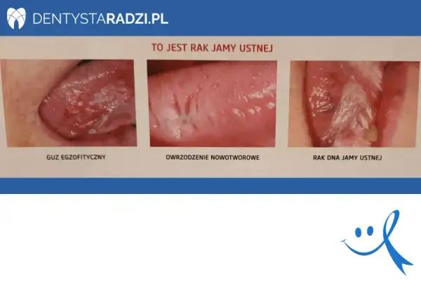 Objawy nowotworu jamy ustnej: Wczesne sygnały ratujące życie