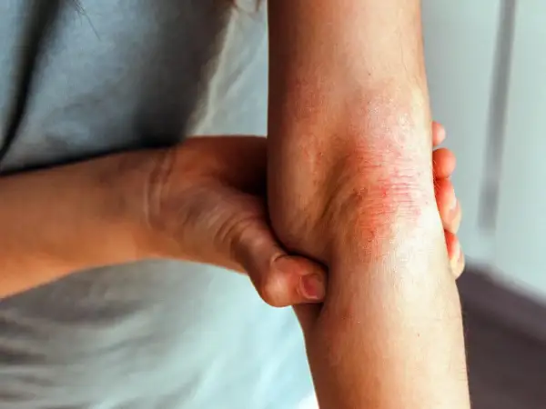 Armbeuge mit geröteter, schuppiger Haut, die stark juckt, typisch für Neurodermitis.