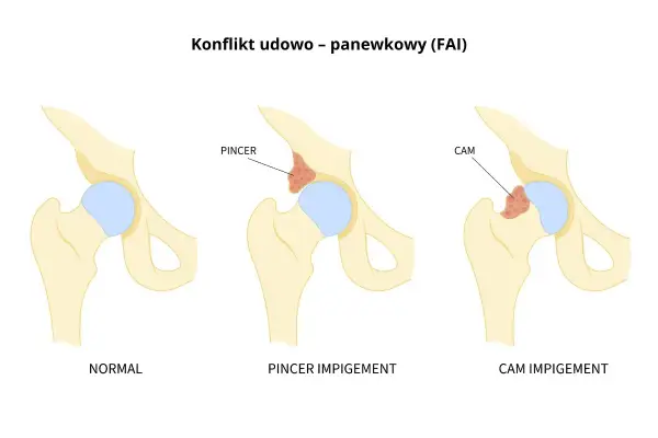 Ilustracja porównująca prawidłowe biodro z biodrem z konfliktem typu PINCER i CAM.