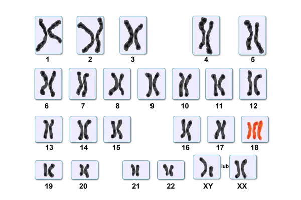 Kariotyp przedstawia pary chromosomów, w tym trzy chromosomy w parze 21, co może wskazywać na zespół Downa.