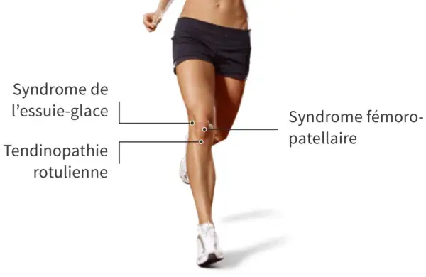 Jambes d'une coureuse, illustrant le syndrome de l'essuie-glace et la tendinopathie rotulienne, causant une douleur au genou externe.