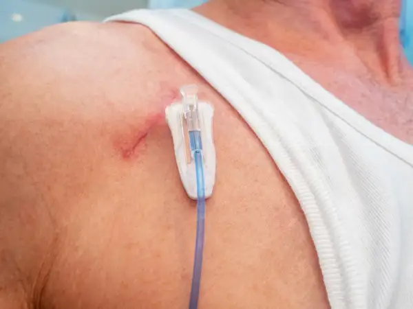 Port-a-Cath für Chemotherapie: Ein Blick auf die Haut mit dem Zugangssystem.