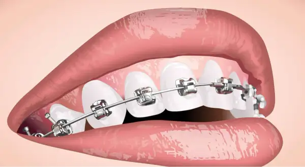Denti con apparecchio metallico, parte di un percorso di cure ortodontiche per un sorriso perfetto.