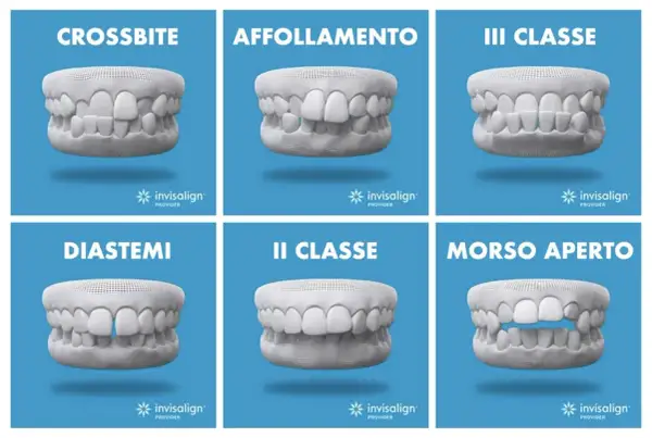 Sei casi di malocclusione dentale: crossbite, affollamento, III classe, diastemi, II classe, morso aperto. Soluzioni con mascherine invisalign.