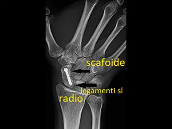 Radiografia del polso con vite nel scafoide mano, evidenziati radio e legamenti.
