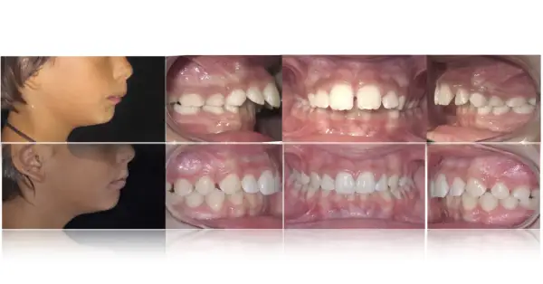Prima e dopo: profilo di un bambino con apparecchio denti sporgenti e immagini ravvicinate dei suoi denti prima e dopo il trattamento ortodontico.