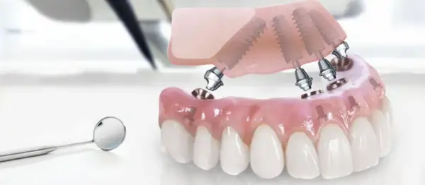 Model szczęki z implantami, gotowy do montażu. Rozważ implanty w Turcji dla pięknego uśmiechu.