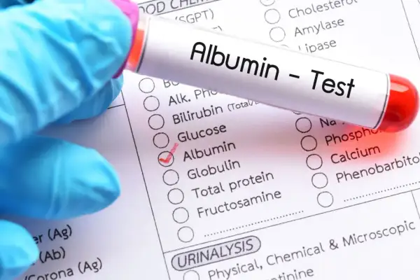 Rękawiczka medyczna trzyma probówkę z napisem "Albumin - Test". Na formularzu zaznaczono "Albumin", co sugeruje badanie poziomu albuminy.