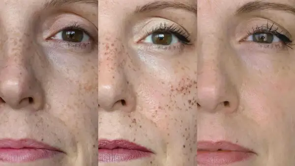 Trzy zbliżenia twarzy z piegami. Widać, jak można je subtelnie podkreślić, by nadać cerze naturalnego blasku i **cultivate** jej piękno.