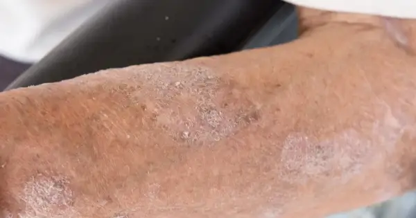Skóra z widocznymi zmianami, łuszczeniem i zaczerwienieniem, sugerującymi problem dermatologiczny, być może orungal.