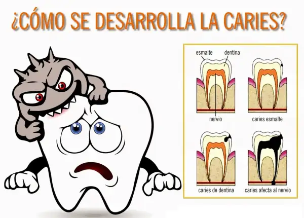 Monstruo atacando un diente triste. Diagramas de etapas de caries dental.