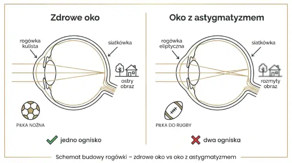 Astygmatyzm a prawo jazdy: zdrowe oko skupia światło na siatkówce, dając ostry obraz. Oko z astygmatyzmem tworzy dwa ogniska, co może wpływać na widzenie podczas prowadzenia pojazdu.