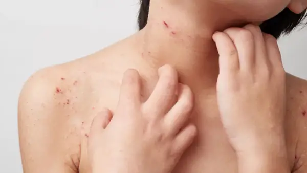 Haut mit roten Flecken und Kratzern, die auf starken Juckreiz hindeuten. Eine Hand kratzt sich am Hals und an der Schulter.