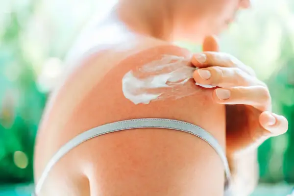 Una mano applica crema doposole su una spalla arrossata dal sole. Utile per lenire e idratare la pelle dopo l'esposizione solare.