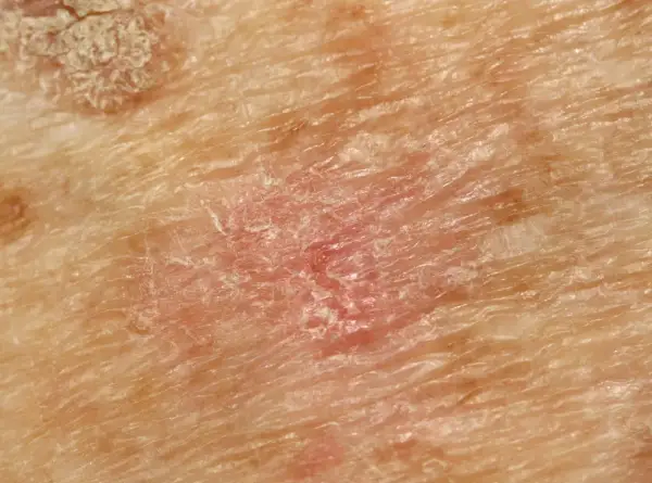 Nahaufnahme von Haut mit Rötung und Schuppung, typisch für aktinische Keratose.