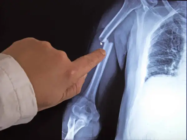 Röntgenbild eines gebrochenen Oberarms. Ein Finger zeigt auf die Bruchstelle. Möglicherweise ein Hinweis auf Knochenkrebs im Alter.