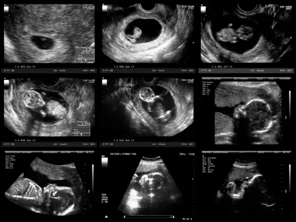Badania prenatalne 2 trymestr: Twój przewodnik po zdrowiu dziecka