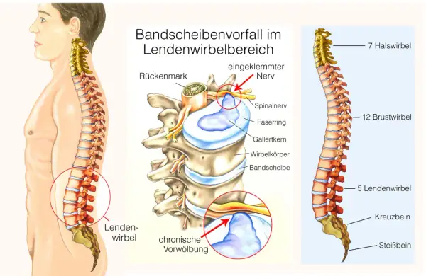 Illustration zeigt Bandscheibenvorfall im Lendenwirbelbereich, der Bandscheibenvorfall schmerzen im bein lindern kann. Eingeklemmter Nerv wird rot markiert.