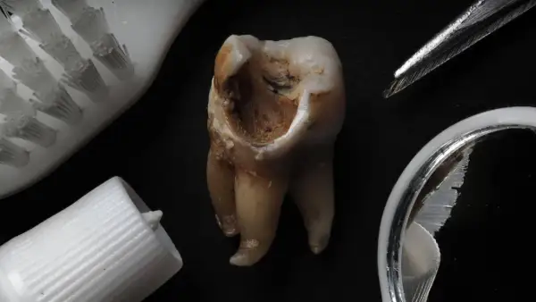 Zniszczony ząb z widocznymi czarnymi kreskami na powierzchni, obok szczoteczki, pasty i pęsety.