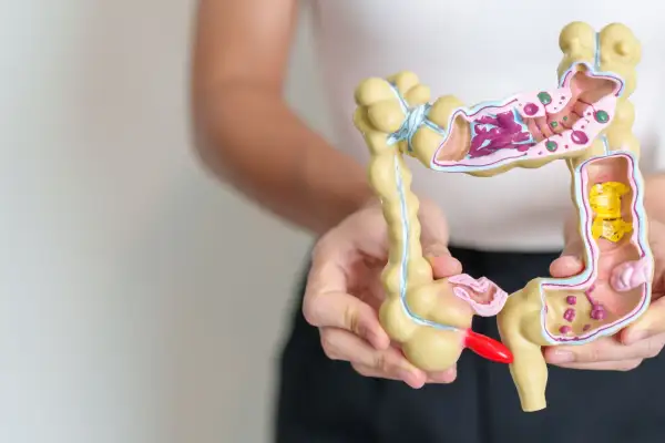 Model jelita z widocznymi zmianami, symbolizujący problemy z jelitem drażliwym.