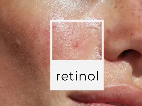Zbliżenie na skórę z niedoskonałościami, w tym pryszczami i bliznami. W ramce napis "retinol co to".