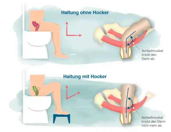 Hockstellung auf Toilette mit Hocker erleichtert den stuhlgang anregen, da der Darm gerade bleibt. Ohne Hocker wird der Darm abgeknickt.