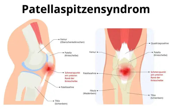 Illustration des Knies mit Hervorhebung des Schmerzpunktes an der Patellasehne, typisch für Patellaspitzensyndrom.