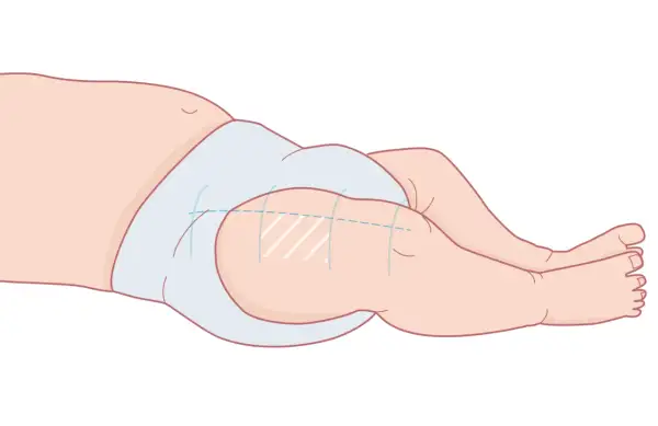 Illustration av ett barns lår med en ljusblå blöja. Markeringar på låret indikerar var 3 månaders vaccin ges.