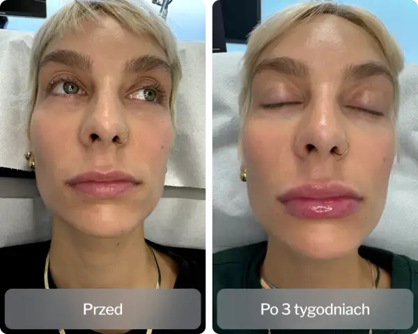 Kwas hialuronowy na co pomaga? Odkryj jego niezwykłe właściwości