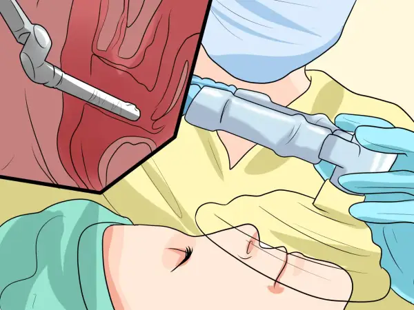 Chirurgie endoscopique pour une cystocèle grade 2. Un instrument médical est inséré dans une zone anatomique.