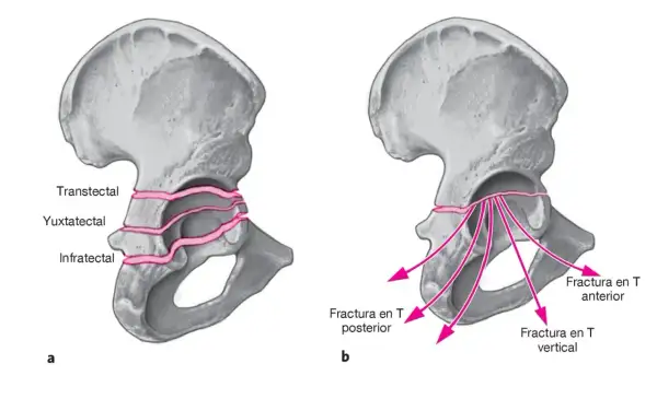 Ilustración de pelvis con fractura en rodete. A muestra tipos transtectal, yuxtatectal e infratectal. B muestra fractura en T anterior, posterior y vertical.
