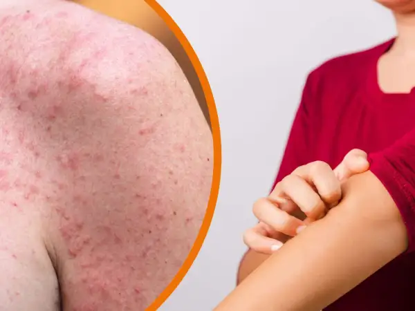 Gerötete Haut mit vielen kleinen Pickeln, die auf Sonnenbrand hindeuten. Eine Hand kratzt sich am Arm.