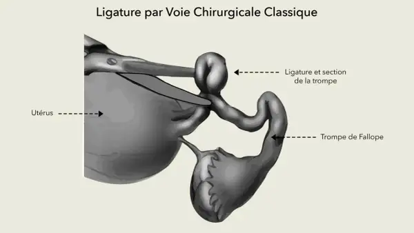 Illustration d'une ligature des trompes par voie chirurgicale classique, montrant l'utérus et une trompe de Fallope ligaturée et sectionnée.