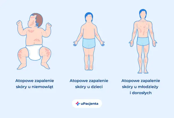 Ilustracja pokazuje, jak egzema u dzieci objawia się na skórze niemowlęcia, dziecka i młodego dorosłego.